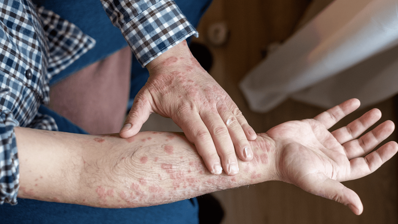 eczema-2024-1280