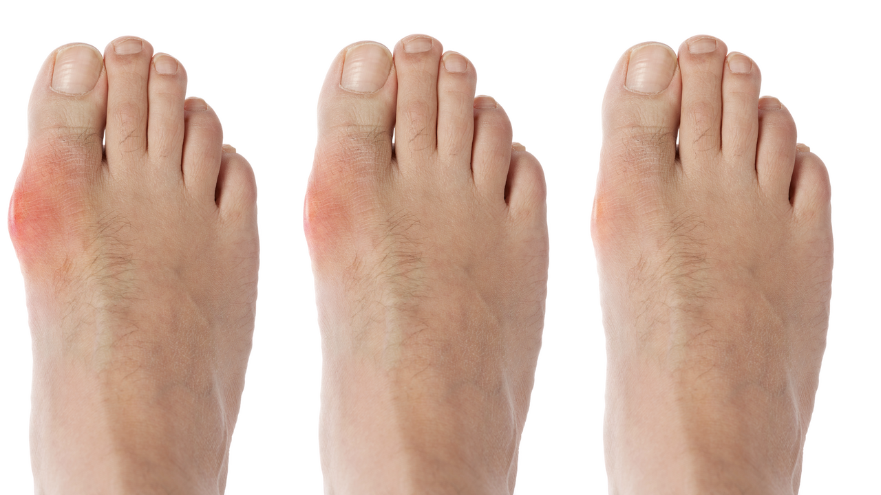 gout-1280