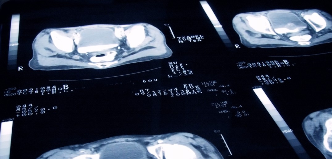 Prostate cancer 1075.jpg