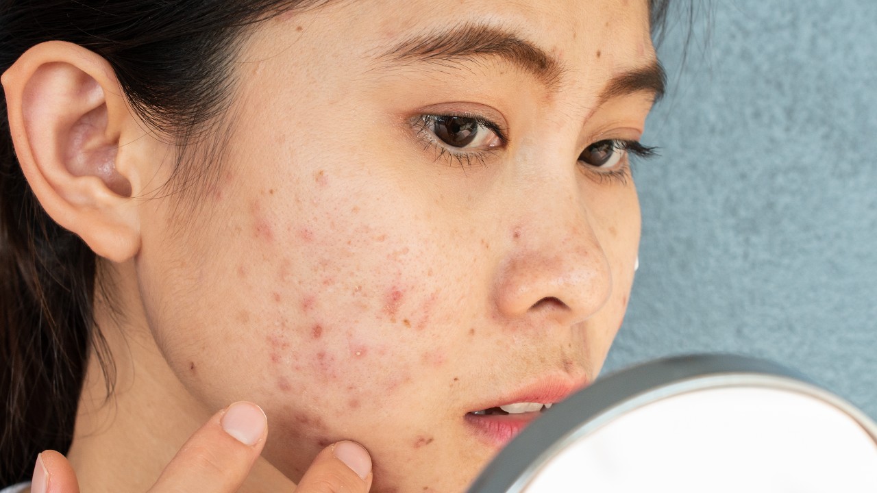 Acne 1280.jpg