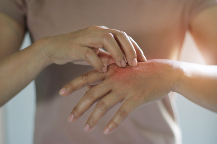 Eczema new.png