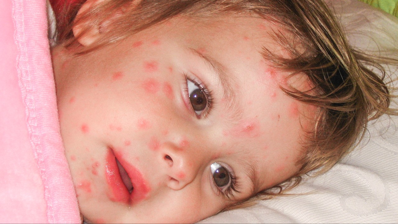 childhood-diseases-1280