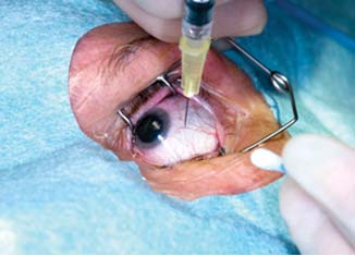 â€¢Eyes right injection_thumb.jpg