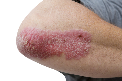 psoriasis_elbow.jpg