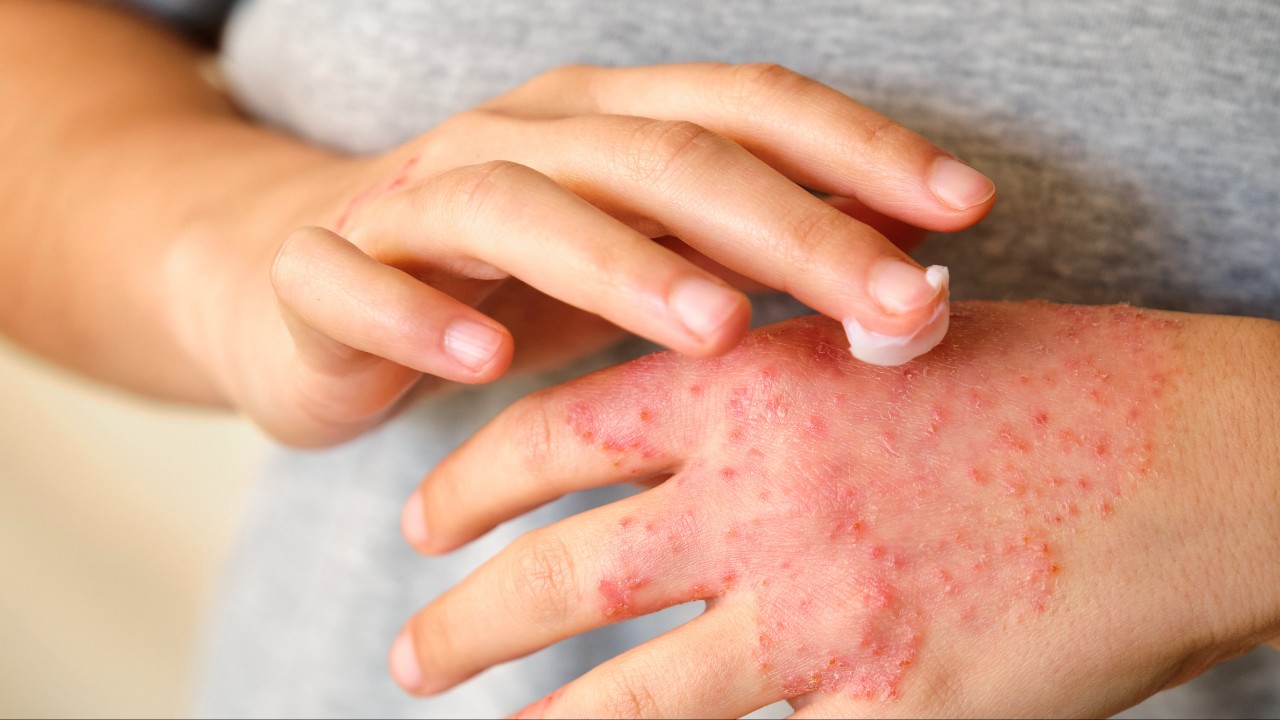 eczema-2025-1280