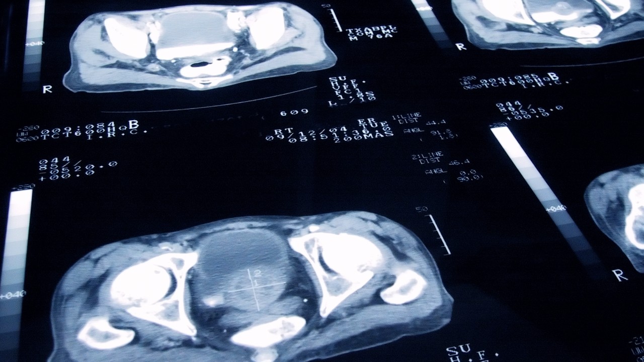 Prostate cancer 1280.jpg