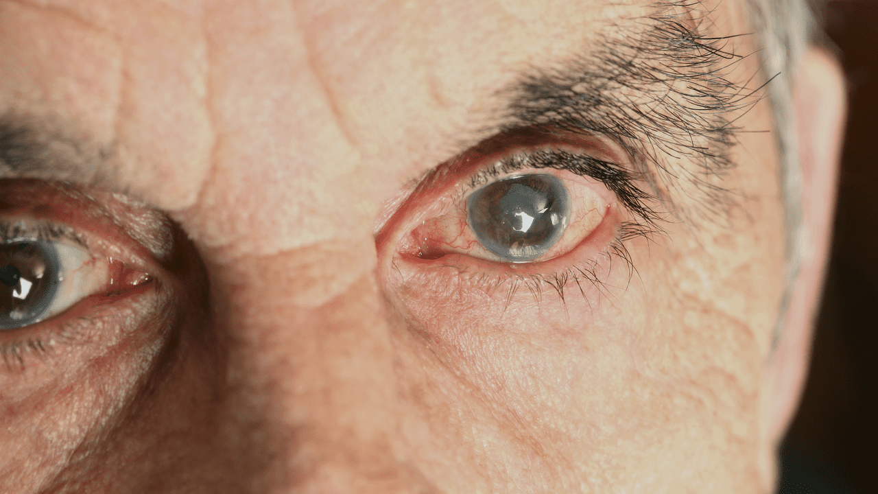 glaucoma-1280