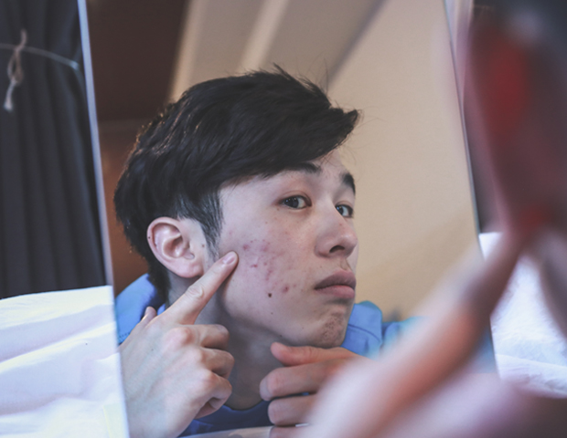 man acne skin_s.jpg
