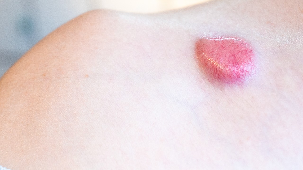 Non-melanoma skin cancer 1280.jpg