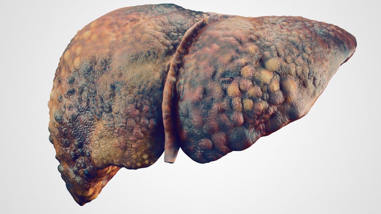 Cirrhosis 1280.jpg