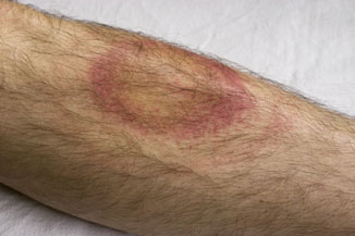 travel_lyme disease rash THUMB.jpg