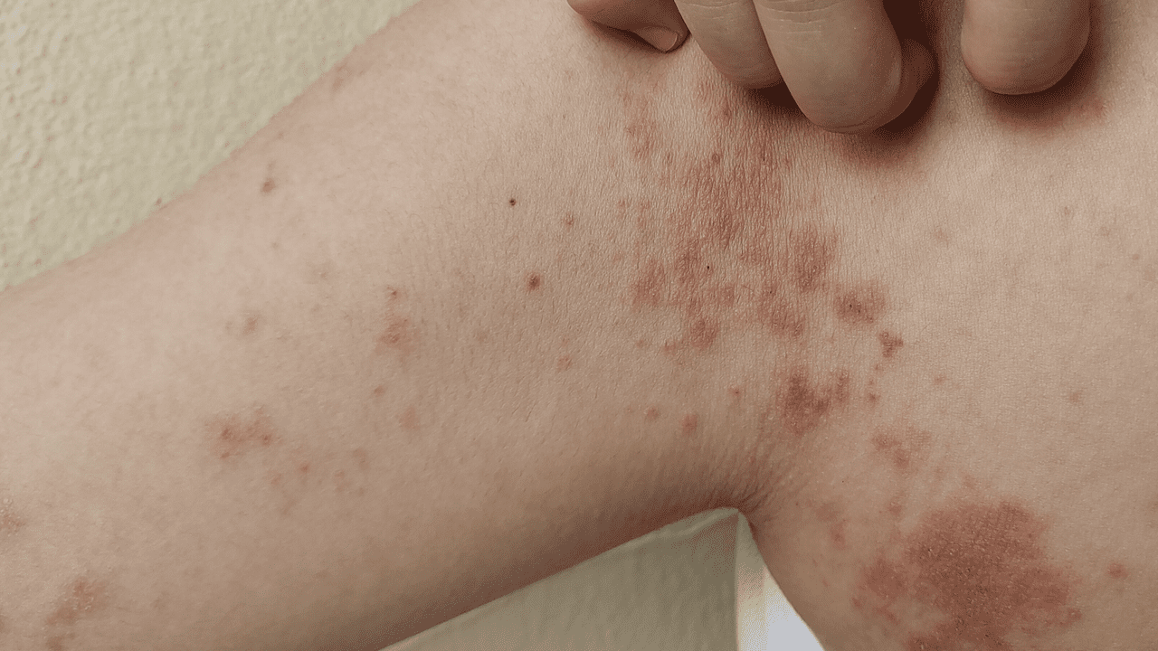 skin-bad-1280