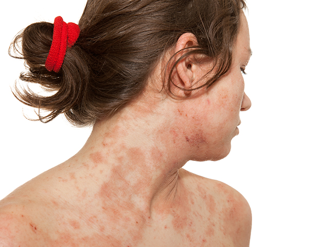 atopic dermatitis summary.jpg
