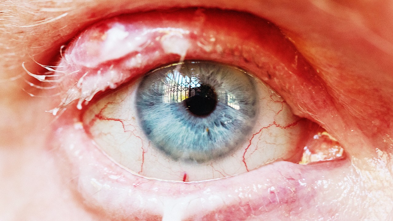 eyelid-1280